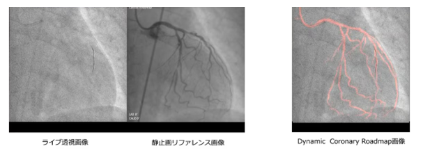 リアルタイム動画ロードマップ機能（Dynamic Coronary Roadmap）